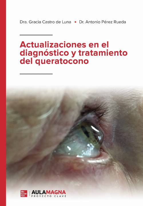 Actualizaciones en el diagnóstico y tratamiento del queratocono